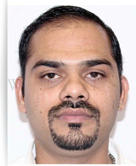 Before hair replacement - male client