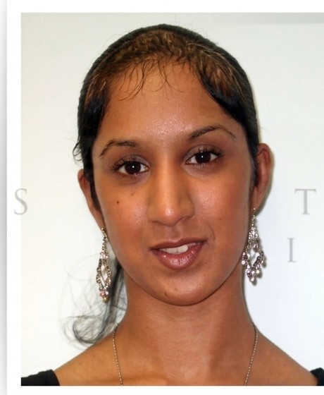 Before hair replacement - female client